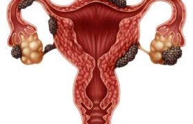 La Endometriosis: Comprendiendo su Impacto en el Cuerpo Femenino